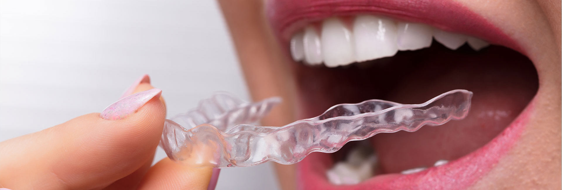 Orthodontic Clear Aligners